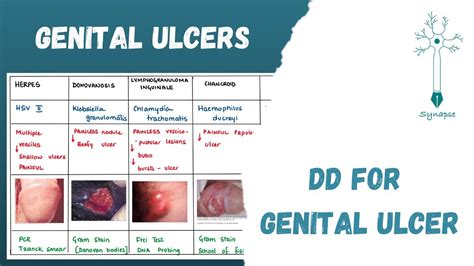 Genital Ulcers Differential Diagnosis Youtube