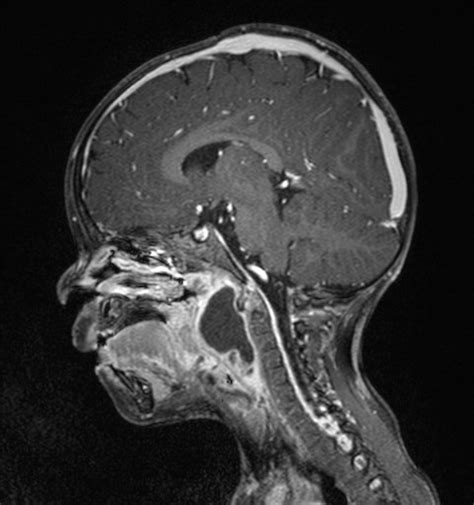 Retropharyngeal Abscess Image