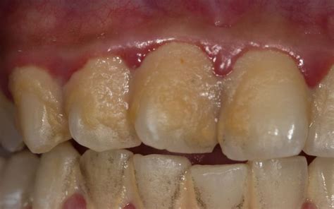 Bacterial Plaque Find Out What It Is And How You Can Fight It🦷 — Prodent