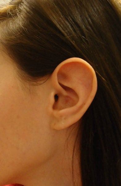Born With Flat Tipped Ears Can Otoplasty Fix The Helix Photo