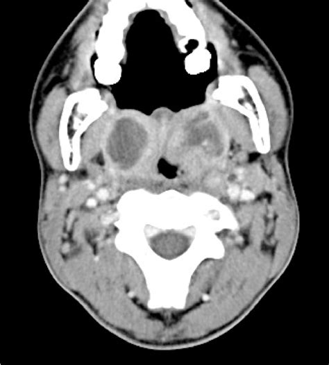 Figure 1 From Bilateral Peritonsillar Abscess A Case Report And