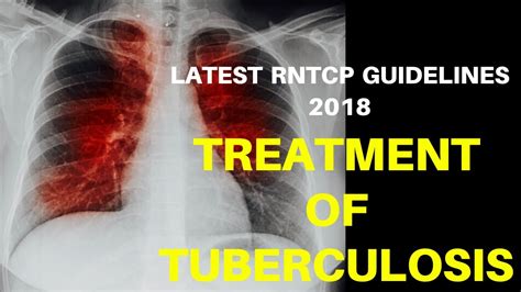 Treatment Of Tuberculosis Latest Rntcp Guidelines 2018 Youtube