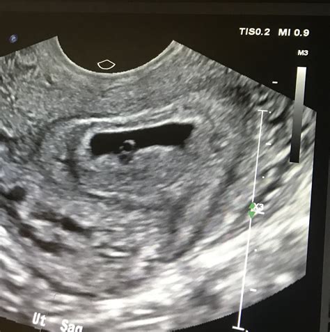 Vaginal Ultrasound 6 Weeks — The Bump