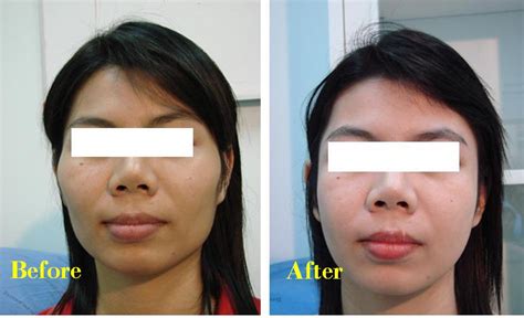 Before And After Photos Of Plastic Surgery Thailand Cheek Bone