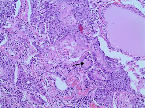 Cureus Primary Squamous Cell Carcinoma Of The Thyroid A Case Report