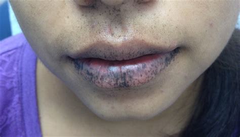 Derm Dx Brown Macules On The Lips Fingers Clinical Advisor