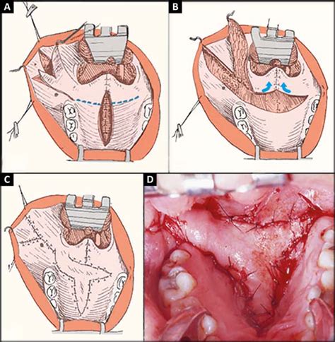 RBCP Correction Of Palatine Fistulas With A Musculo Mucosal