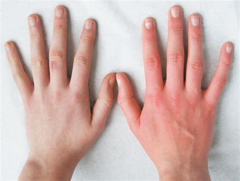 A White Hand And A Red Hand — Erythromelalgia Nejm