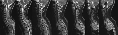 Spinal Schwannoma Radiology Cases