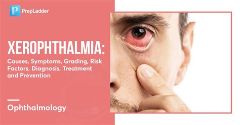 Xerophthalmia Symptoms Causes And More With Images