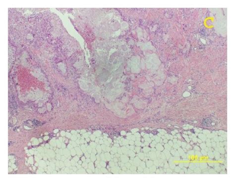 Skin And Subcutaneous Lesion A Ulcer And Erythematous Nodule In