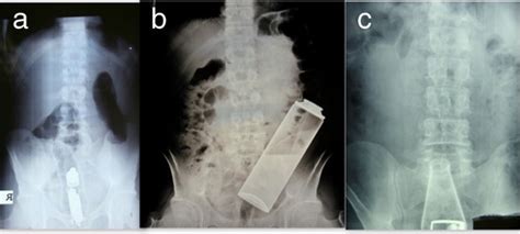 Colorectal Emergencies Associated With Penetrating Or Retained Foreign