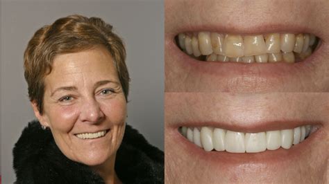 Before And After Composite Veneers Treatment 8
