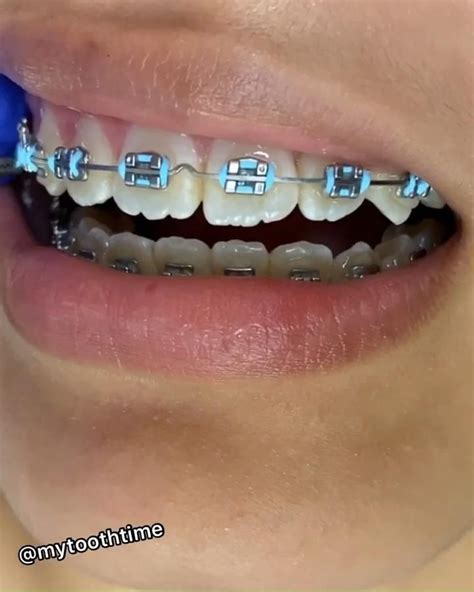 Braces Time Video Braces Teeth Colors Dental Braces Colors