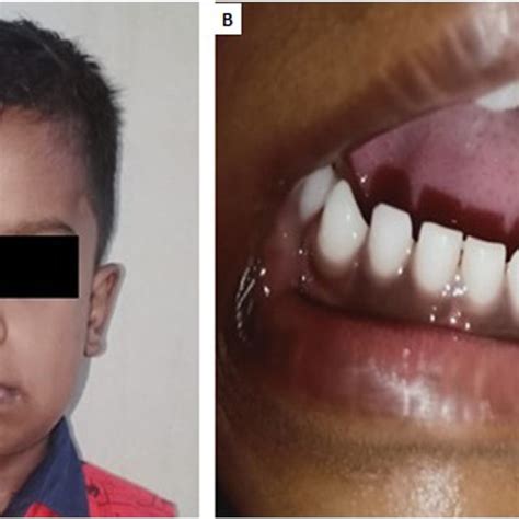 A Diffuse Swelling With A Mild Facial Asymmetry In The Left Mandibular