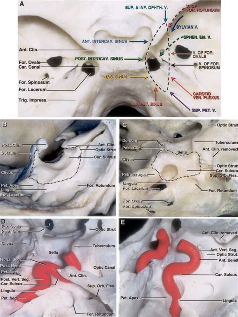 Cavernous Sinus The Neurosurgical Atlas By Aaron Cohen Gadol Md