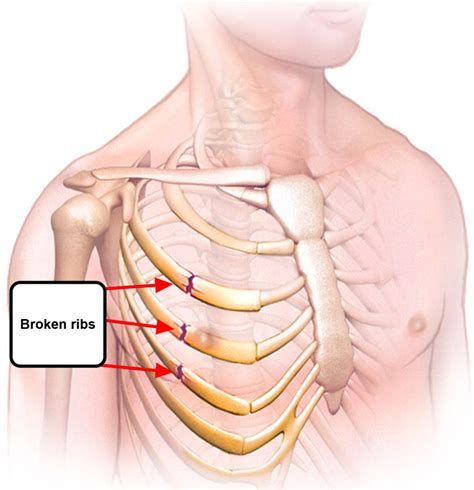 Broken Rib Causes Signs Symptoms Recovery Time Treatment