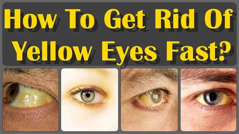 How To Get Rid From Yellow Eyes With Naturally Foods And Get White Eyes Youtube