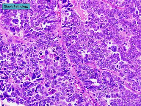 Qiaos Pathology Ovarian High Grade Serous Carcinoma A Photo On
