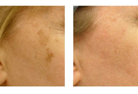 Brown Spots Age Spots And Tattoo Removal San Diego