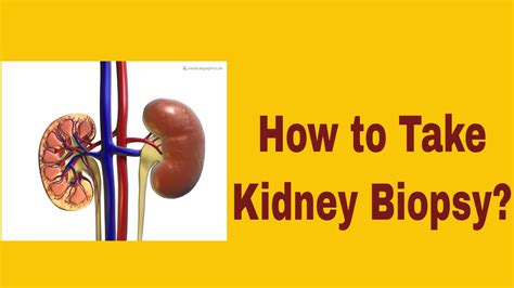 Kidney Cancer Biopsy Procedure Youtube
