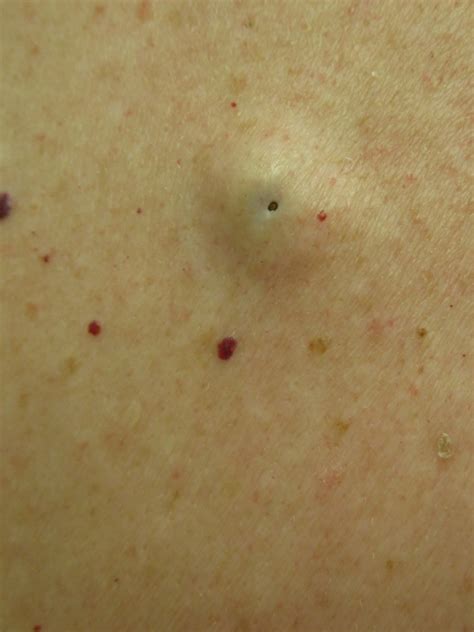 Epidermoid Cyst International Journal Of Clinical And Medical Images