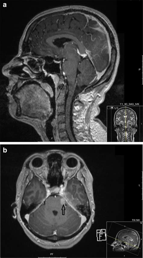 A Sagittal Mri Scanning Before Initiation Of Oncological Treatment No