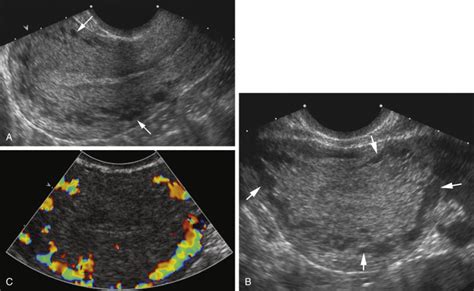 Ultrasound Evaluation Of The Uterus