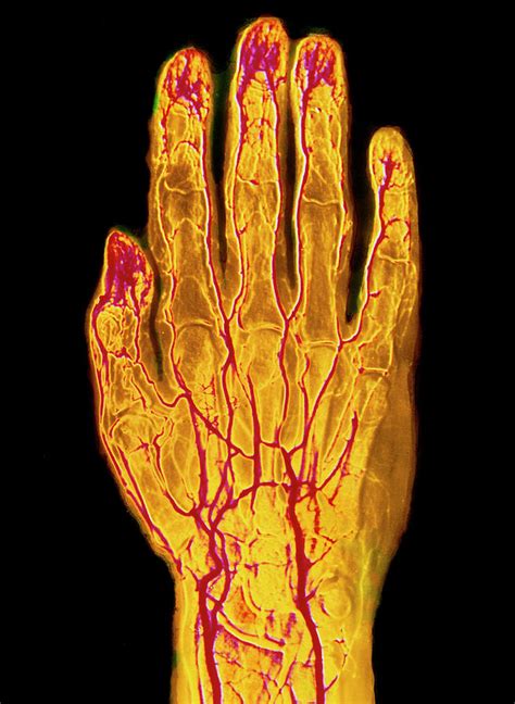 Fcol Arteriogram Of Human Hand Photograph By Alain Pol Ismscience