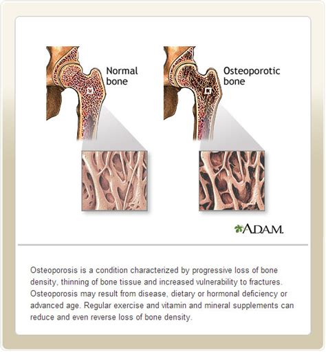 What Is Bone Density Newlifeoutlook Osteoporosis