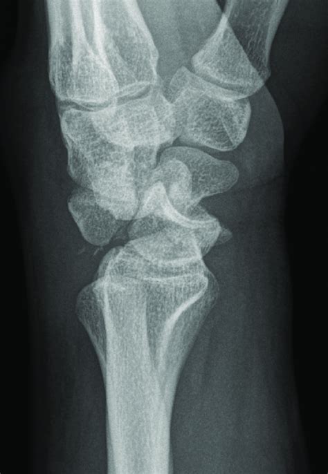 Lateral Radiograph Of A Dorsal Perilunate Fracturedislocation
