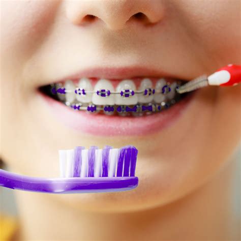 Orthodontic Hygiene Treatment Cleaning Braces The Dental Hygienist