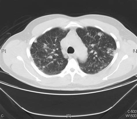 Nodular Sarcoidosis CT Scan Nodular Lung Lesions Are Rep Flickr