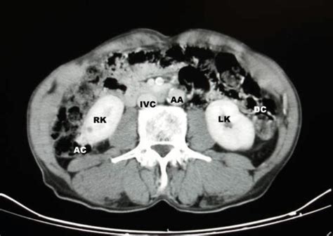 Abdominal Ct Scan At The Level Of The Lower Pole Of