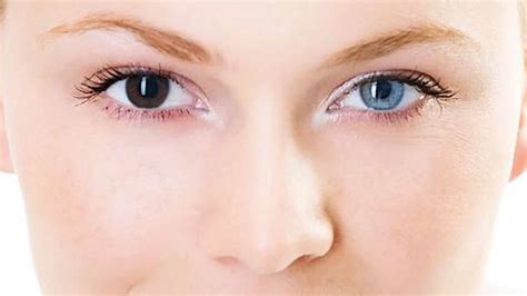 Heterochromia Eyes In Humans Causes How Rare Is Heterochromia Iridis
