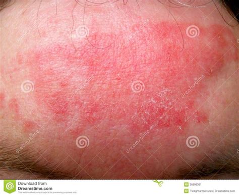 Eczema Contact Dermatitis Red Eczema Forehead Sponsored Contact
