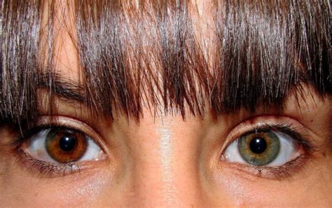Olhos Com Cores Diferentes Entenda O Que Pode Ser Viva Oftalmologia