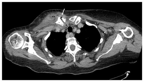 JBJI Sternoclavicular Joint Septic Arthritis In A Healthy Adult A Rare Diagnosis With