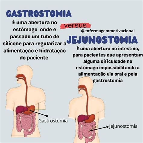 RESUMOS DA ENFERMAGEM on Instagram GASTROSTOMIA E JEJUNOSTOMIA São