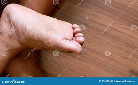 Athlete`s Foot Tinea Pedis Fungal Infection Stock Photo Image Of