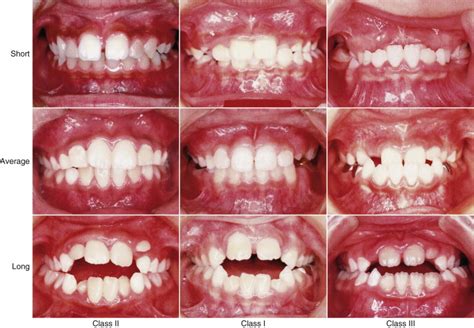 Types And Causes Of Malocclusion David F Urich Dds