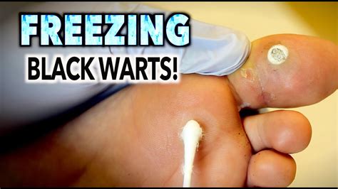 freezing black warts dr paul youtube