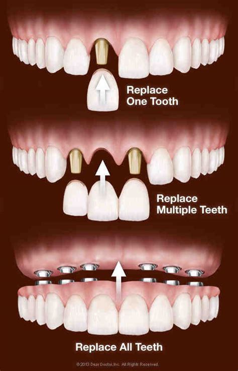 How Is A Dental Implant Done Dental News Network