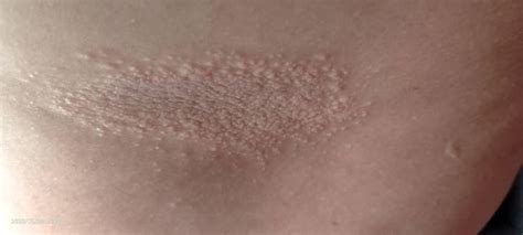 What Is This Lesion Rdermatologyquestions