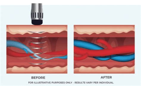 RejuvaWAVE Shockwave Reverses ED Associated With High Cholesterol Simply Men S Health Male
