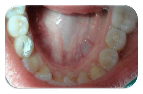 After Access Opening Dens Evaginatus In Right And Left Premolars