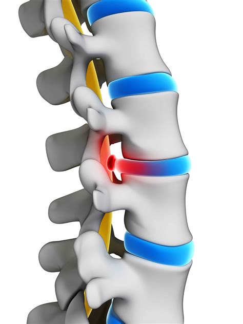 Herniated Disc — Epic Pain Management