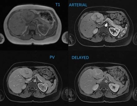 Focal Nodular Hyperplasia Radiology Reference Article Radiopaedia Org