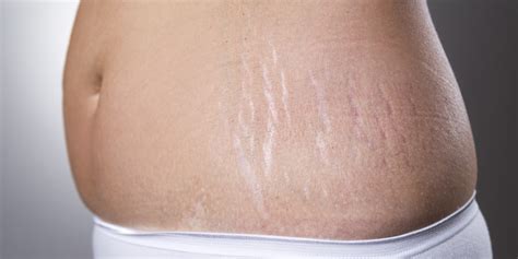 Myths About Stretch Marks To Stop Believing Huffpost