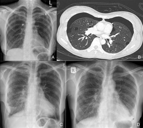 A Chest X‐ray Showing Bilateral Pneumothorax With Both Chest Tubes In